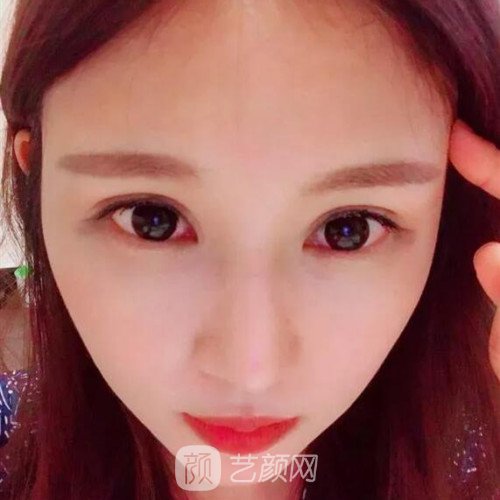 成都銅雀臺雷剛雙眼皮修復案例分享，半個月果圖~